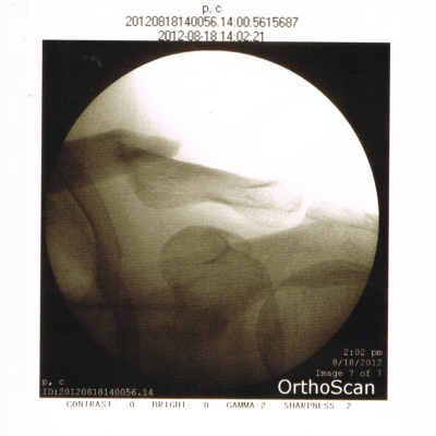 My Collarbone 8/18/2012